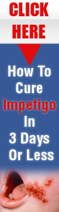 How to Cure Impetigo